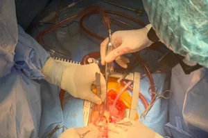 Cứu sống bệnh nhân bị u tim lớn tuổi nhất miền Tây