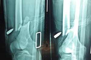 Vụ nổ súng ở Củ Chi: Nạn nhân bị thương đang được điều trị