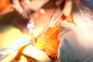 Ngực thủng sâu sau 2 lần qua Trung Quốc bơm silicon