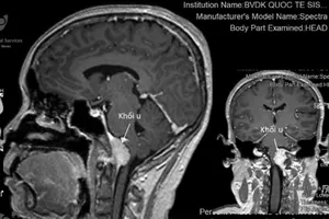 Tưởng chóng mặt do rối loạn tuần hoàn, té ra bị u não hiếm gặp