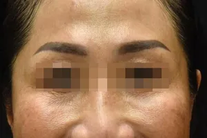 Tiêm độc tố botulinum để làm đẹp da