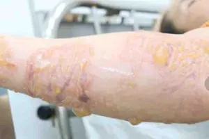 Bỏng da nặng do sứa biển “cắn”