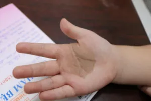 Chân tay trẻ có dát nâu đen, cha mẹ chớ coi thường