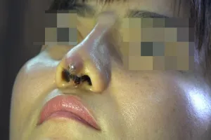 Lâm Đồng: Trụ mũi đứt lìa do 'bác sĩ thẩm mỹ' rởm 