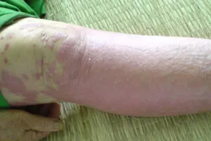 Tin vui cho người bị bệnh vảy nến