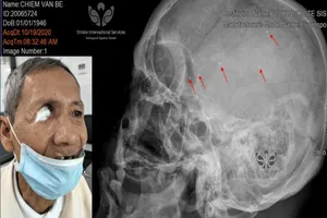 Sắp gắp ra hàng trăm mảnh đạn trong đầu bác thương binh 