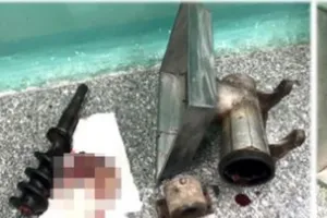 Cho bệnh nhân ngủ để cắt bỏ tay bị cuốn vào máy xay thịt