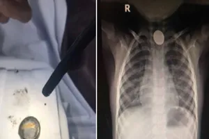 Nuốt viên pin cúc, thực quản bé trai 4 tuổi bỏng nặng
