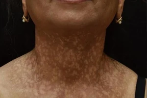 Bệnh hiếm gặp: Rụng tóc xơ hóa vùng trán kết hợp phẳng sắc tố