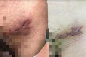 Nam thanh niên mắc cùng lúc 2 bệnh giang mai và hột xoài