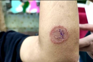 TP.HCM: Thú cưng làm 4 người trong nhà cùng 'mọc nấm'