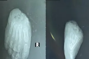 Bàn chân đứt lìa của bé trai 6 tuổi được cứu qua 5 lần phẫu thuật