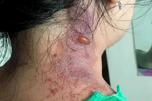 Viêm da tiếp xúc do kiến ba khoang nhưng bị 'phán' Zona thần kinh