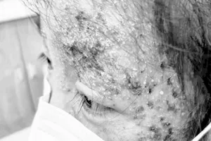 'Trăm hoa đua nở' trên mặt do tự mua thuốc trị nấm về bôi