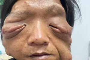 Tìm lại ánh sáng mắt trái cho chàng trai dân tộc Dao