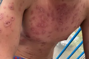 Tưởng dị ứng thuốc, té ra mắc hội chứng hiếm gặp ở nam giới