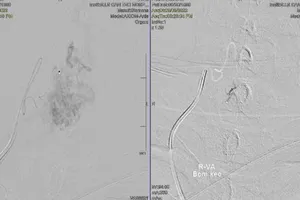 Đi đứng bình thường sau 13 năm yếu liệt 