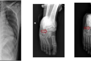 Liệt 2 chân do rơi từ trên cao khi đang sửa thang máy