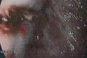 Vỡ thực quản sau cuộc nhậu buổi trưa