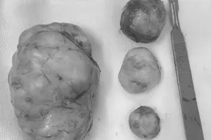 Ngỡ bụng to do mỡ, không ngờ mang 4 khối u 