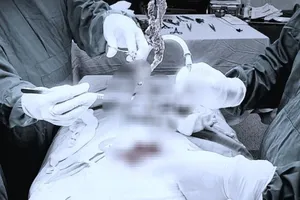 Tắc ruột phải mổ cấp cứu do tự ăn tóc