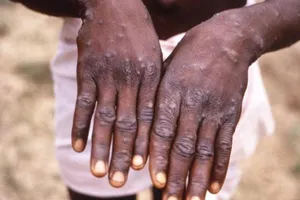 TP.HCM xét nghiệm trường hợp có thể dương tính bệnh đậu mùa khỉ