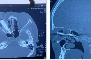 Tai họa bất ngờ: Đinh dài 5 cm xuyên mắt phải 