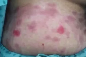 Uống viên làm đẹp da thải độc tố, cô gái nhiễm độc nặng 