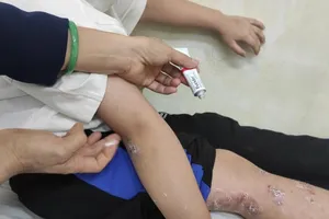 Đừng để trẻ bị chốc khi tới trường