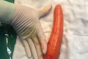 Quýnh quáng tìm bác sĩ sau khi đút cà rốt 'khủng' vào hậu môn 