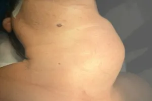 'Giải cứu' khối u khủng đóng vôi cho một bệnh nhân nữ