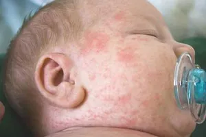 Lo sợ khi bé nổi ban