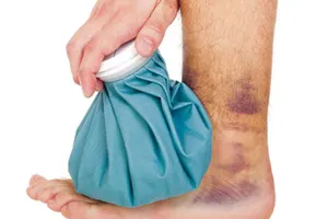 Bong gân, có nên bó thuốc?