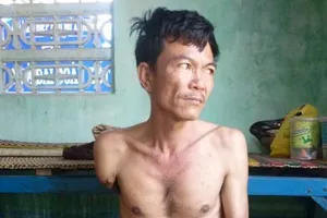 Bị rụng dần chân tay