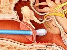 Màng nhĩ rách có thể tự lành