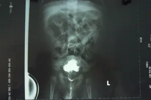 Trẻ bị vỡ bàng quang do dị tật niệu