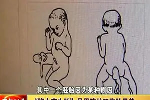 Bé trai 2 tuổi "mang thai" người anh em sinh đôi