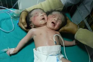 Bé gái hai đầu với hy vọng sống mong manh