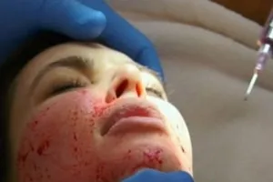 Hút máu người để kéo dài tuổi xuân?