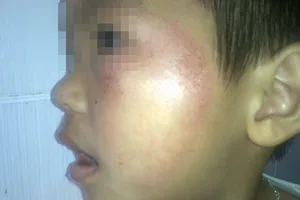 Trẻ mầm non bị mẹ hiệu trưởng dùng dép đánh vào mặt