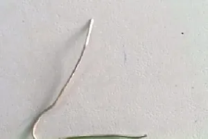 Nội soi lấy cọng kim loại trong phế quản bệnh nhân