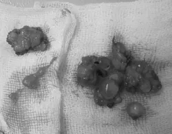 Một phụ nữ tử vong sau khi bơm silicon lỏng khắp người