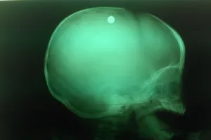 Trẻ bị đạn ghim vào đầu vì chị gái nghịch súng tự chế