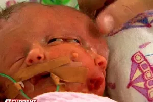 Trẻ sơ sinh có hai khuôn mặt 