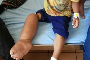 Một trẻ có chân bị thắt vòng