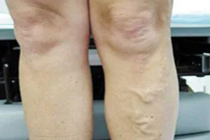 Cảm giác kiến bò dưới da, là bệnh gì?