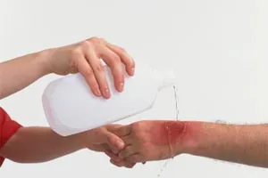 Sơ cứu bỏng lửa, nước sôi 