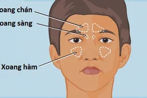 Cách nào biết trẻ bị viêm xoang? 