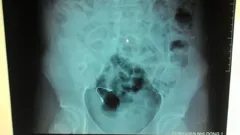 Ngủ dậy, phát hiện niềng răng lọt vào bụng