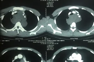 Cảnh giác với hiện tượng vướng khi nuốt, khó thở khi nằm